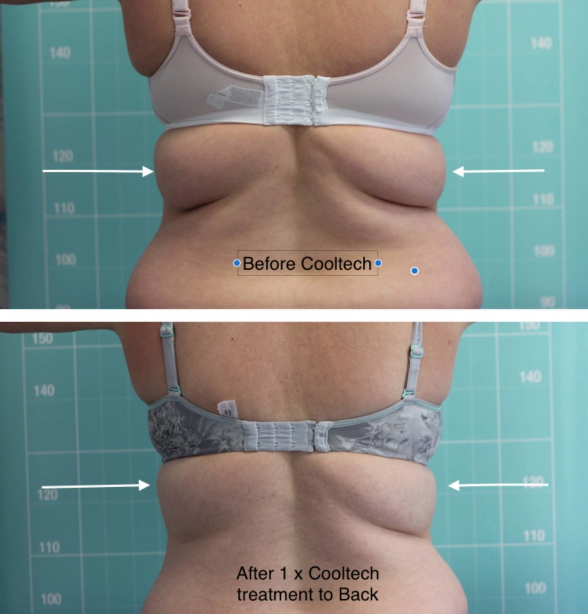 Bra-Fat Reduction Treatments - Berkeley Body Sculpting