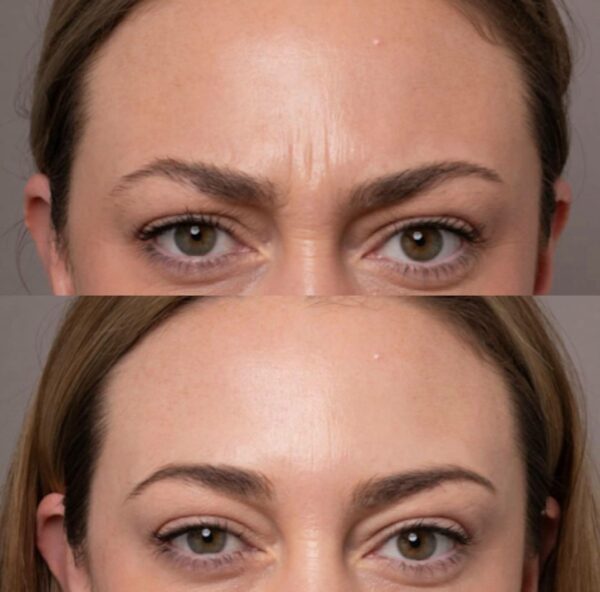 Anti Wrinkle Injections 6888