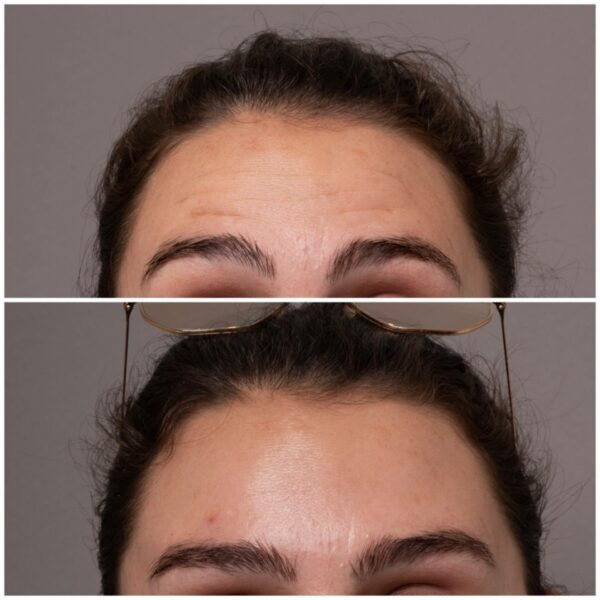 Anti Wrinkle Injections 8844