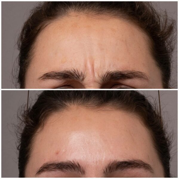 Anti Wrinkle Injections 8846