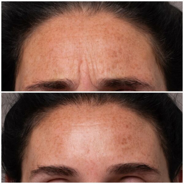 Anti Wrinkle Injections 9288