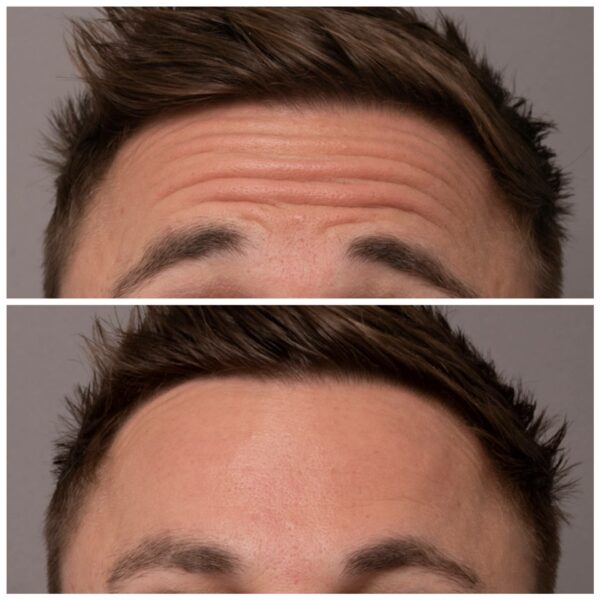 Anti Wrinkle Injections Image3